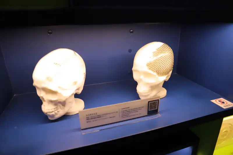 3Dプリンタで製作し、チタン製プレートが装着された頭蓋骨